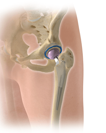 Graphic showing hip replacement in the hip anatomy