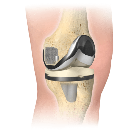 Knee Replacement graphic showing where a knee replacement goes in the knee anatomy