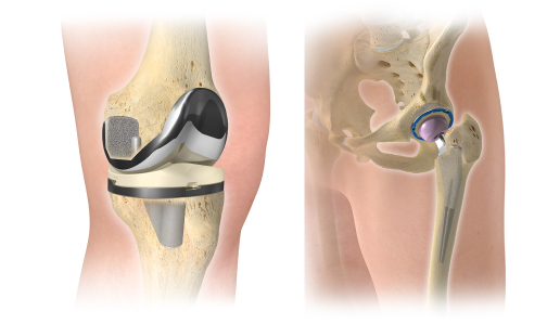 knee and hip replacements